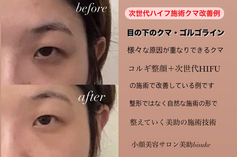 目元のクマ改善方法の一つとして次世代ハイフがおすすめ ブログ