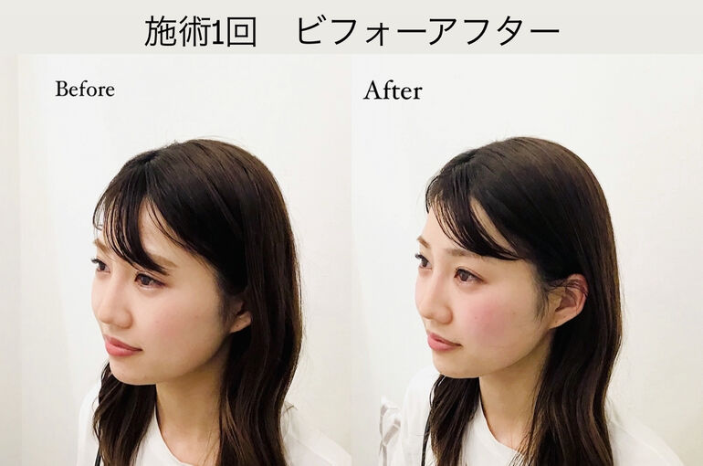 フェイスライン施術1回の効果（ビフォーアフター） | ブログ