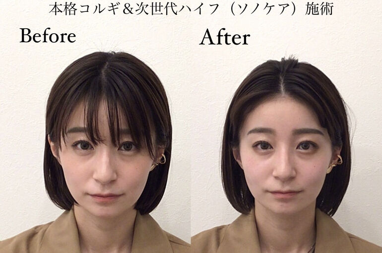 本格コルギ、施術1回でも変わるビフォーアフター | ブログ