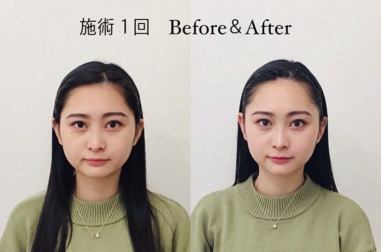 「変わるコルギ/小顔バランス矯正」ビフォーアフター | ブログ