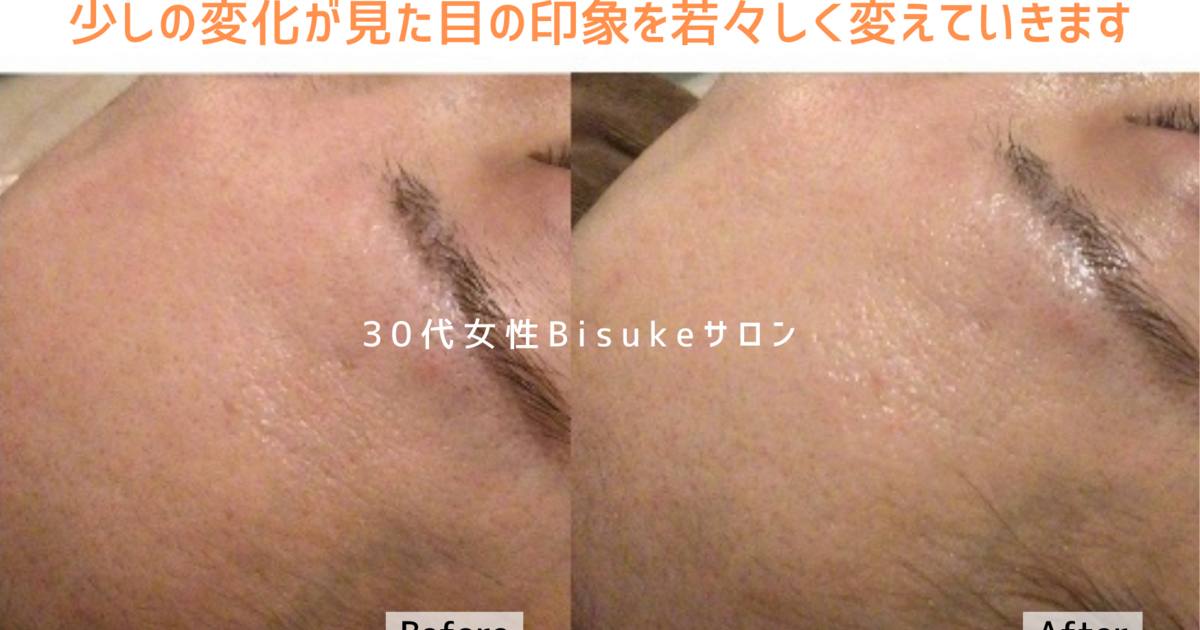 複数割引☆ララピールの進化版サロン専売品☆プラピール3set9回分14,400円