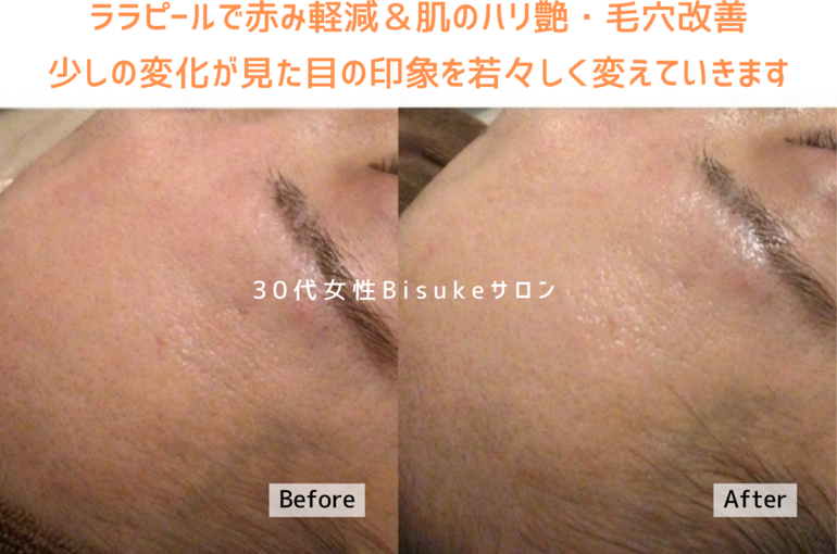 南青山・外苑前 BISUKEサロン「ララピール効果」 | ブログ