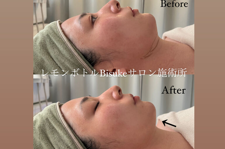 レモンボトル」ビフォーアフター | ブログ