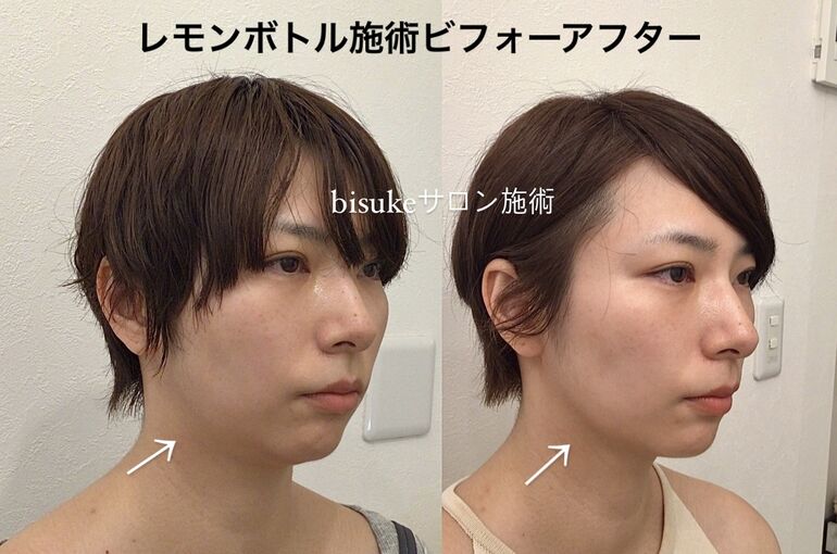 レモンボトル施術 ビフォーアフター | ブログ