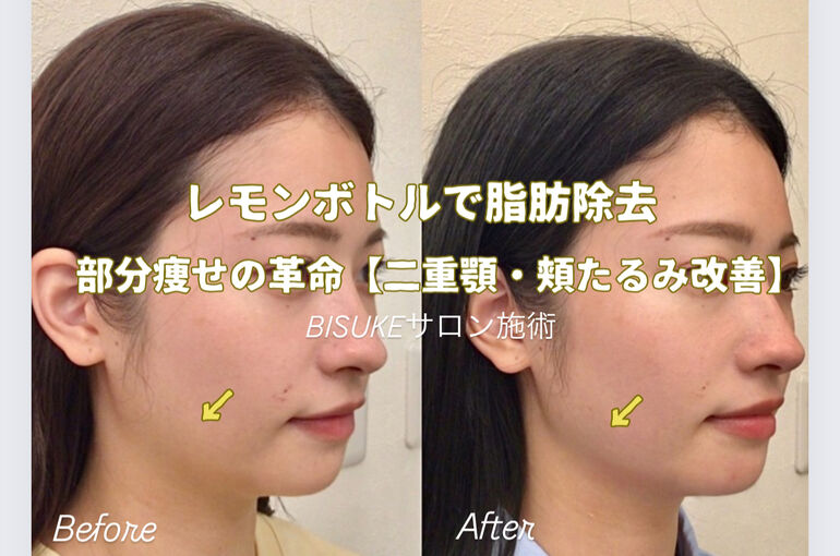 部分痩せレモンボトル「二重あご改善」ビフォーアフター | ブログ