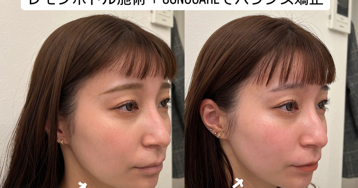 レモンボトルで顔バランスの調整「ビフォーアフター」 | ブログ