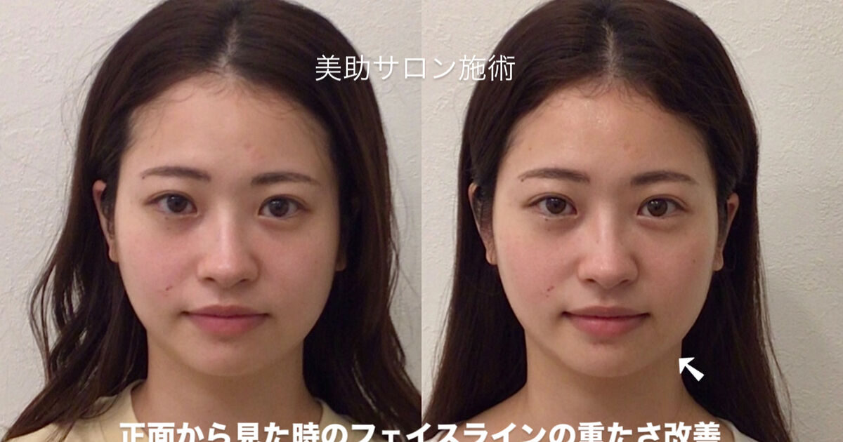 レモンボトルを活用した小顔矯正」ビフォーアフター | ブログ