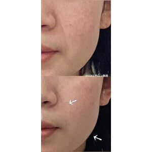 レモンボトル＋リジュランピールでたるみ改善 | ブログ