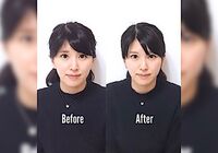 小顔矯正